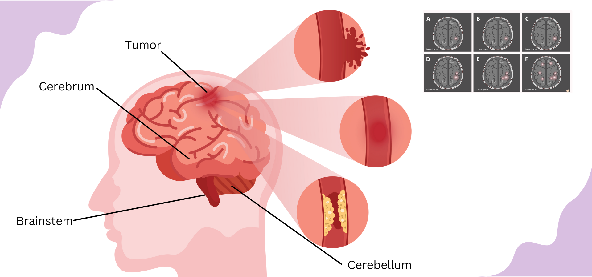 Brain Tumors